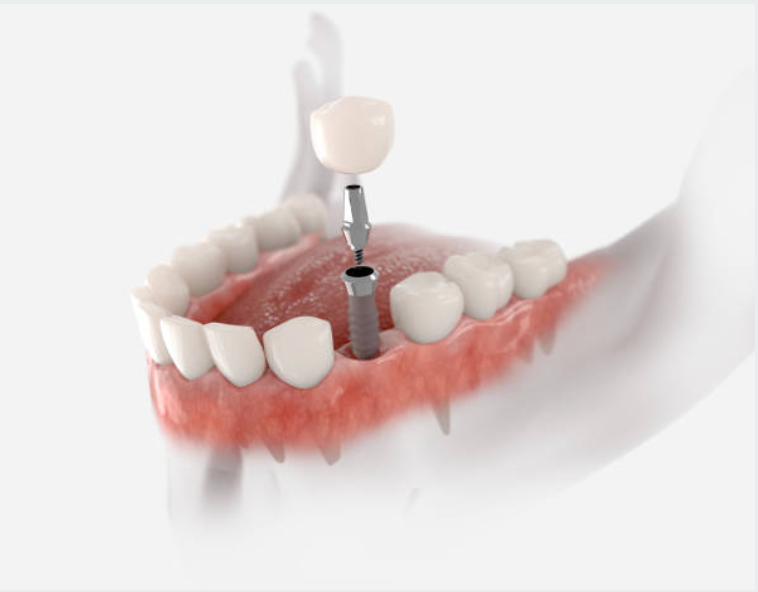 Couronne sur implant